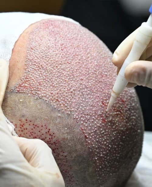 Direct Hair Implantation