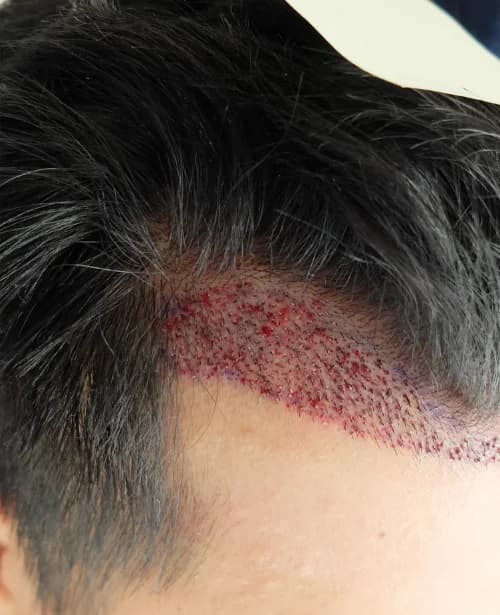 Follicular Unit Extraction