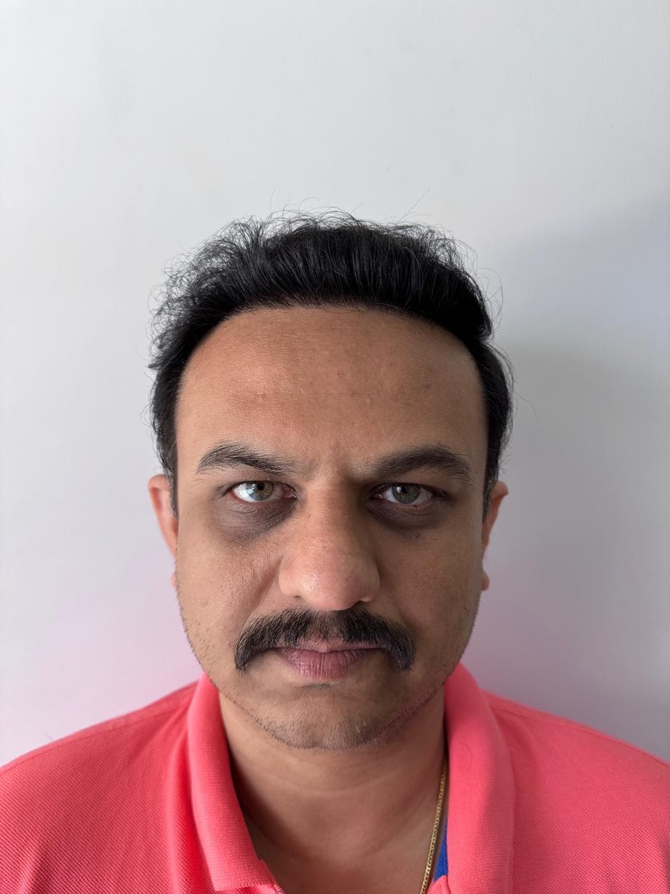 after hair transplant