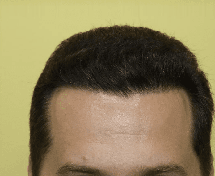 after hair transplant