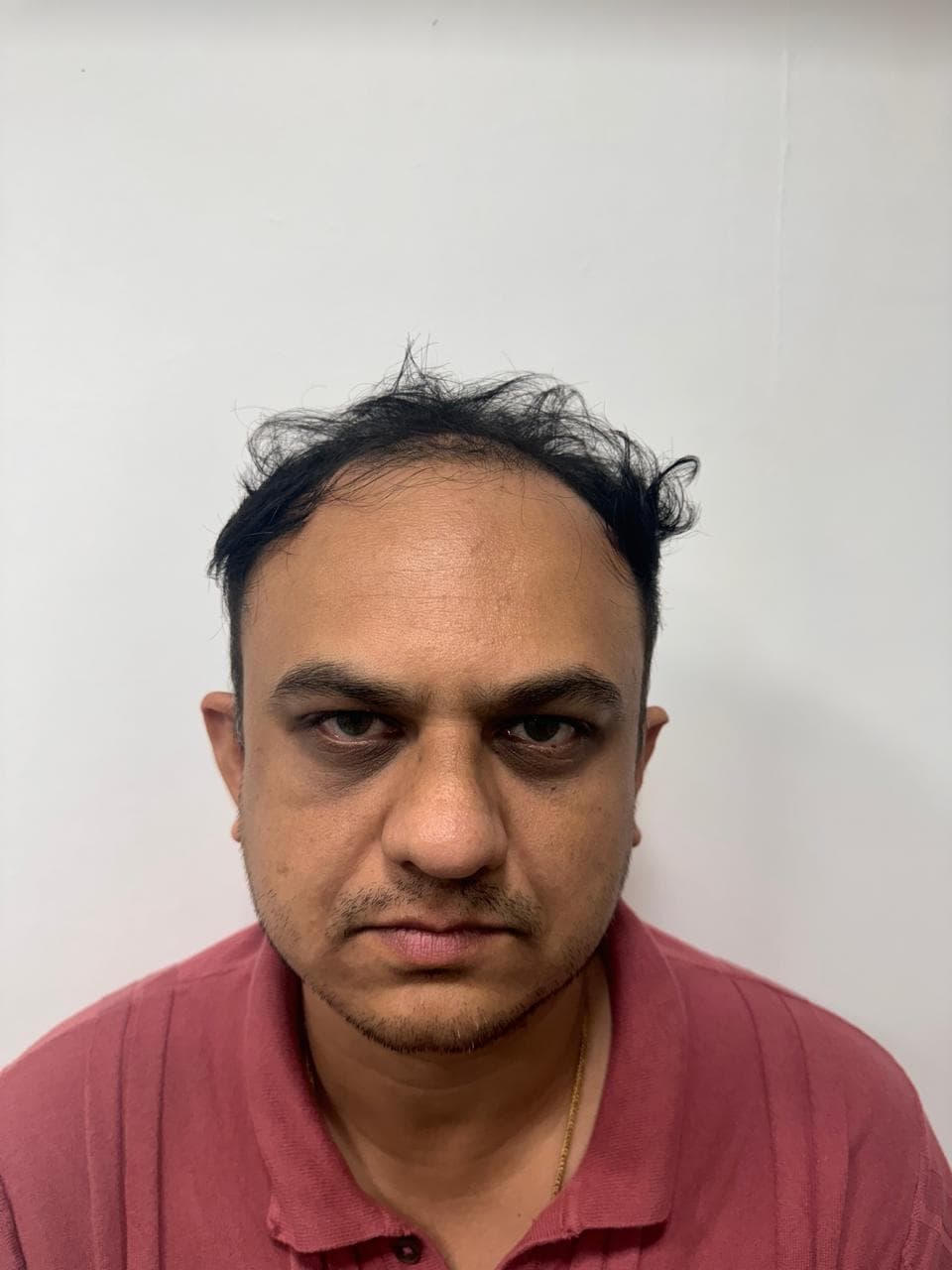 before hair transplant