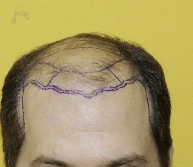 before hair transplant