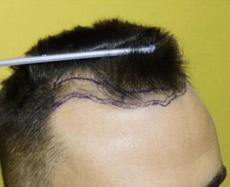 before hair transplant