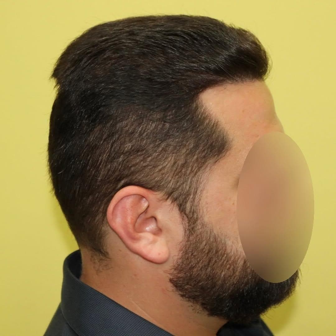After hair transplant