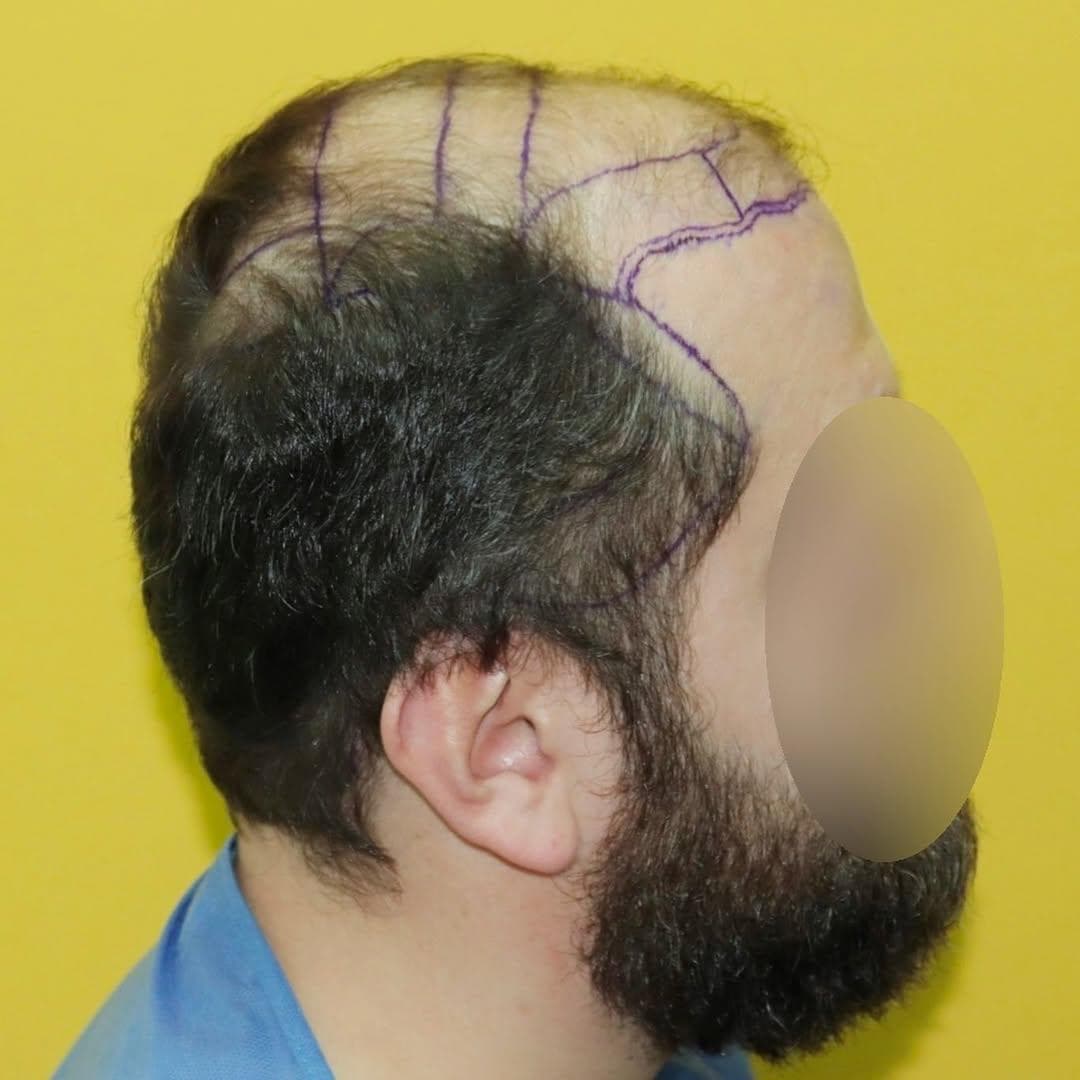 Before hair transplant